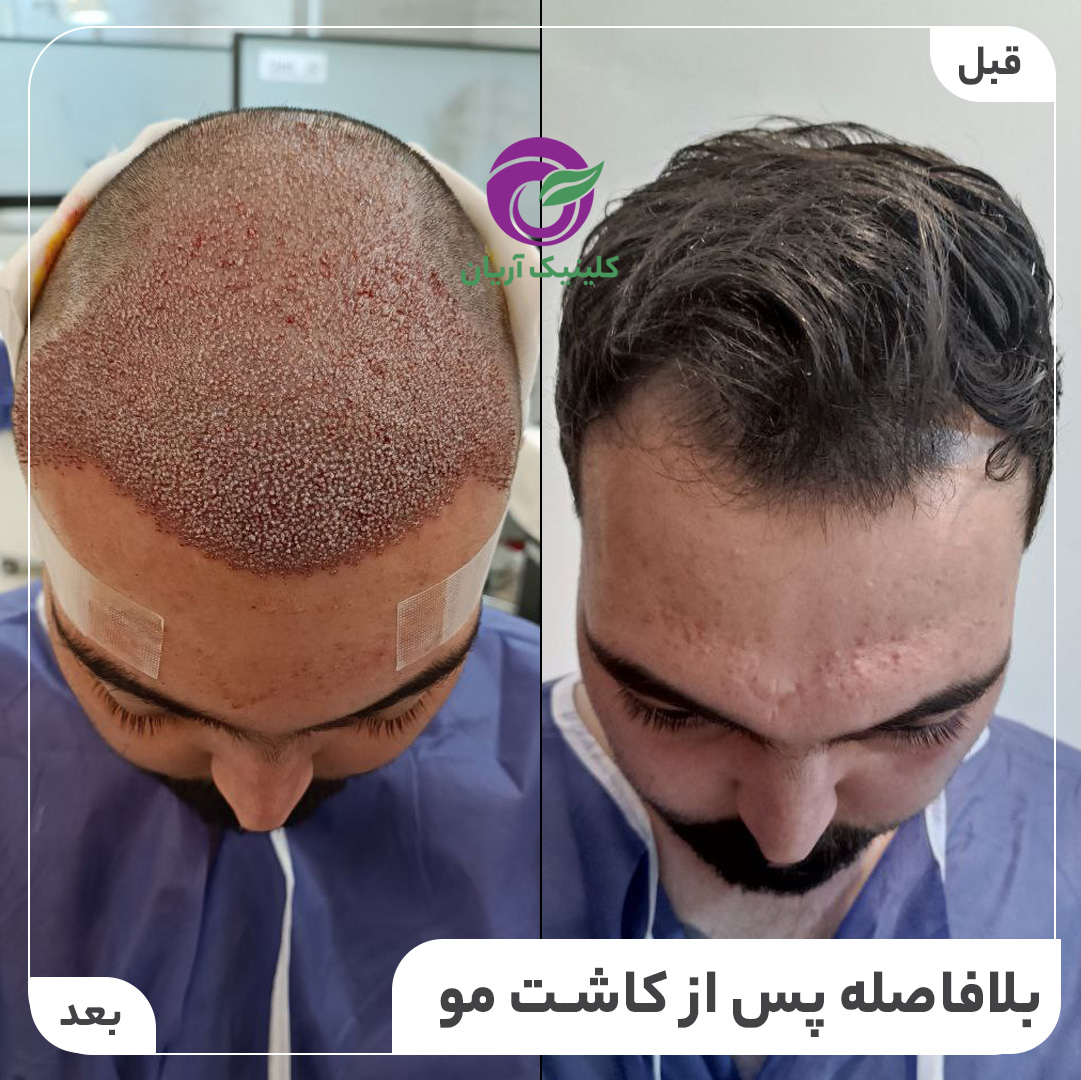 گالری کاشت مو 